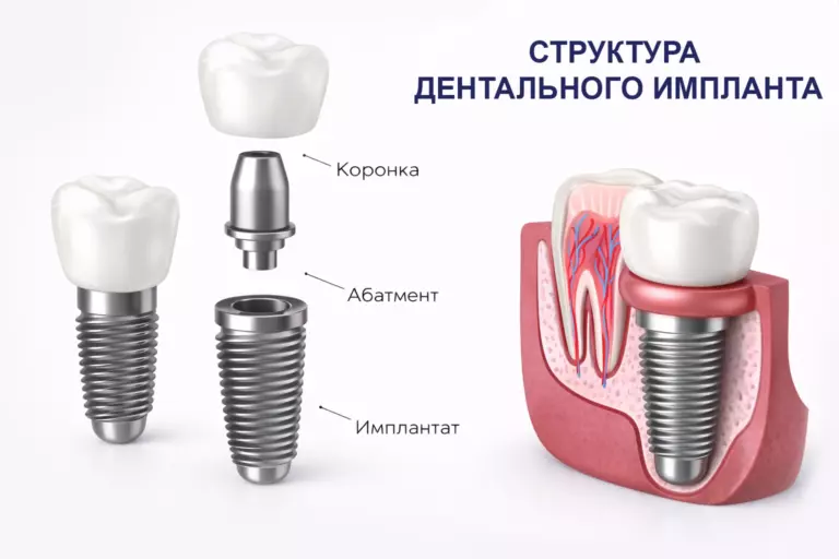 Имплантация зубов в Томске, структура дентального импланта